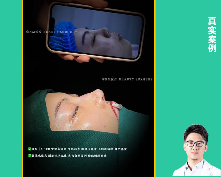 Kes-kes yang sebenar mengenai tulang rusuk hidung| Tulang tulang rusuk membentuk hidung lurus semulajadi