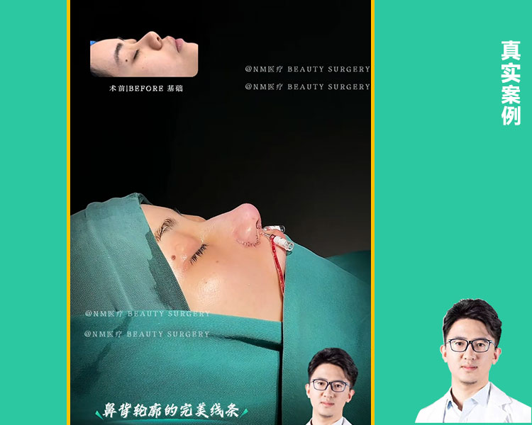 Kes-kes pembaikan hidung yang rumit| Rekonstruksi hidung kontraktor · tulang rawan rib untuk membina semula stent hidung